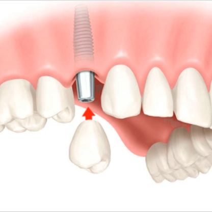 Consulta Odontológica Gorka Ibarlucea esquema implante dental 