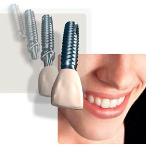 Consulta Odontológica Gorka Ibarlucea sonrisa de persona con diferentes tipo de implante dental