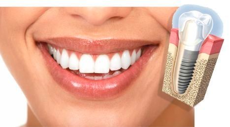 Consulta Odontológica Gorka Ibarlucea mujer sonriendo con esquema de implante dental 