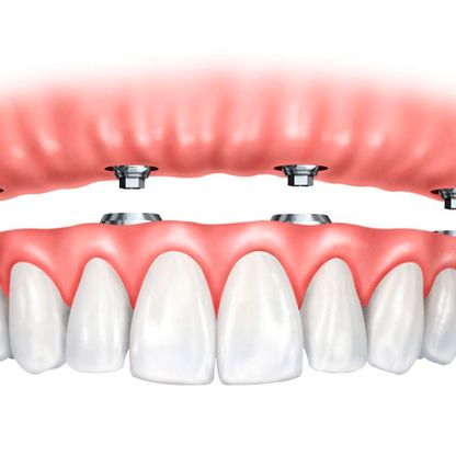 Consulta Odontológica Gorka Ibarlucea esquema prótesis dental 