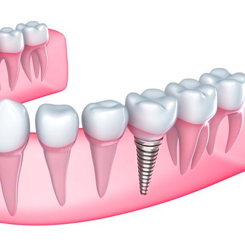 Consulta Odontológica Gorka Ibarlucea muestra de diente con implante 